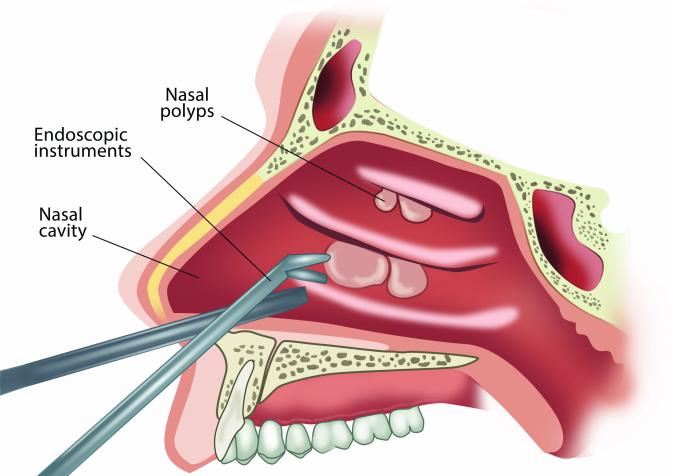 Nasal Polyps removal surgery