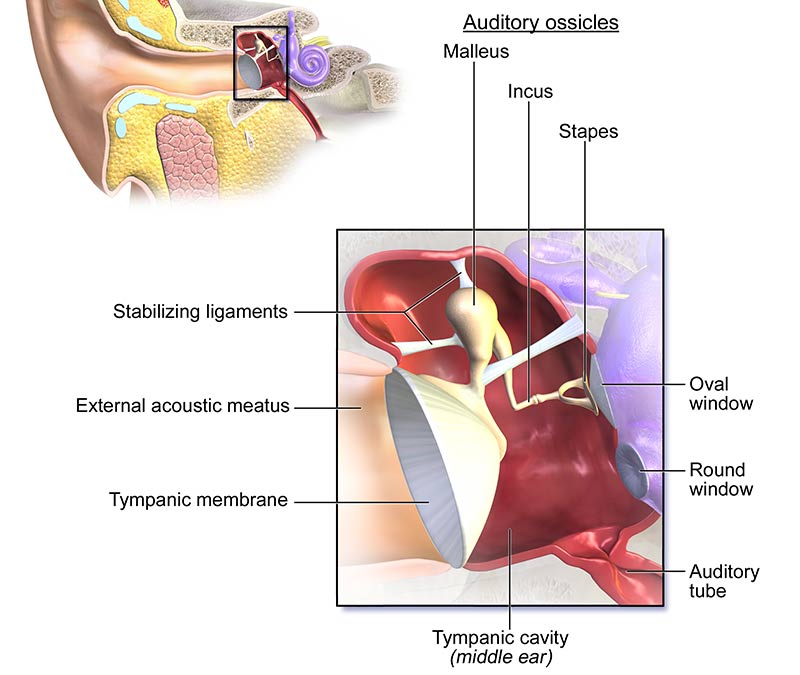 Otosclerosis