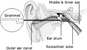 insertion of grommet